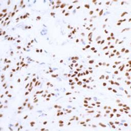 Detection of human SOX10 in FFPE melanoma by IHC.