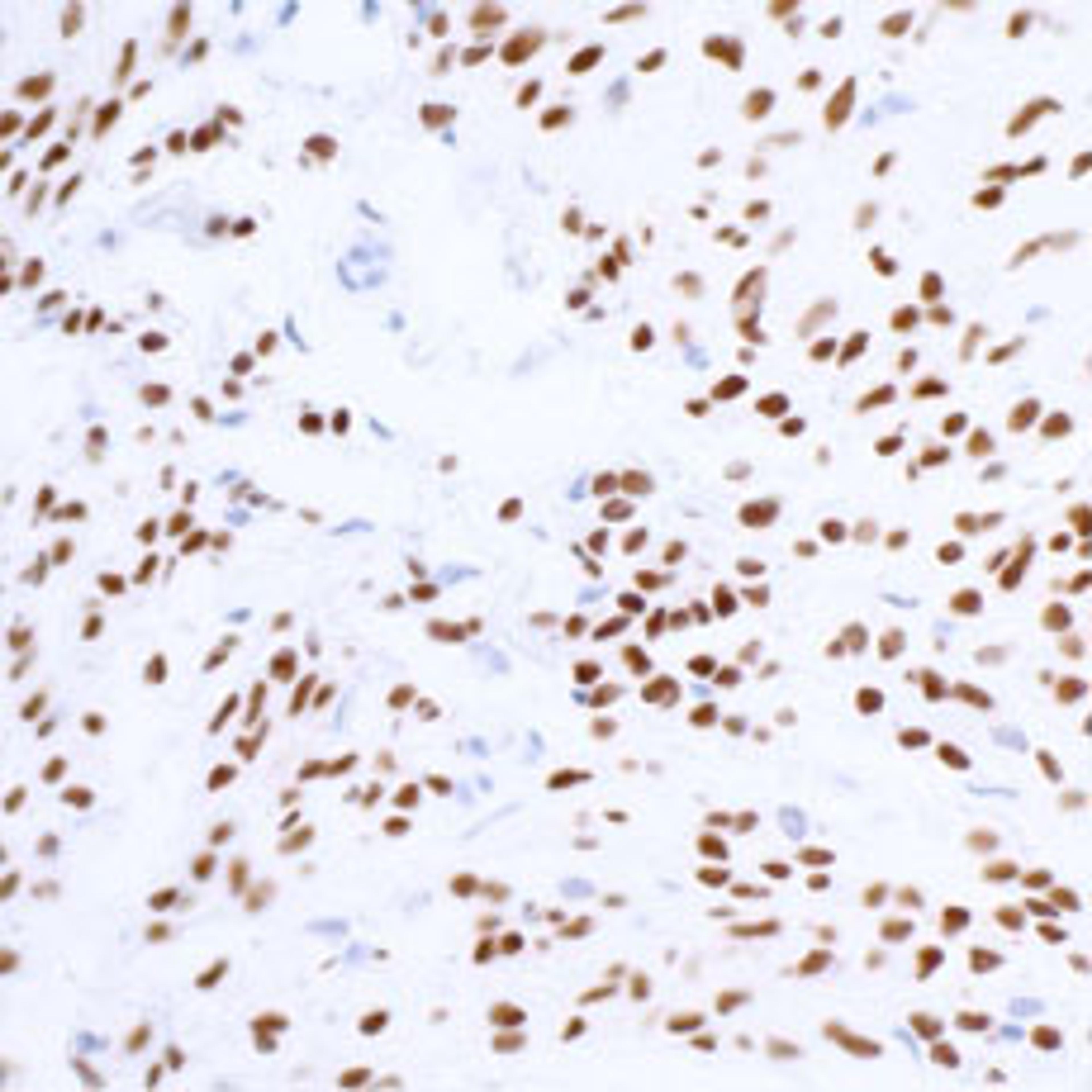 Detection of human SOX10 in FFPE melanoma by IHC.