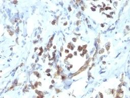 Formalin-fixed, paraffin-embedded human gastric carcinoma stained with PAX6 antibody (PAX6/1166).