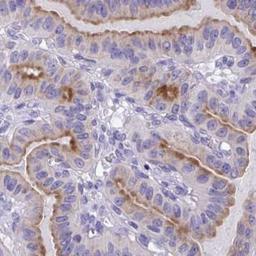 Immunohistochemistry: TMEM106B Antibody [NBP2-31714] - thyroid cancer