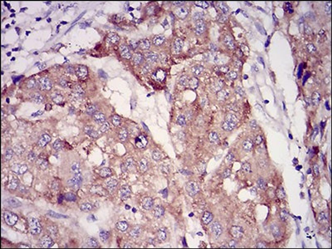 Immunohistochemistry: Rab27a Antibody (7D7C9) [NBP2-37248] - Immunohistochemical analysis of paraffin-embedded liver cancer tissues using RAB27A mouse mAb with DAB staining.