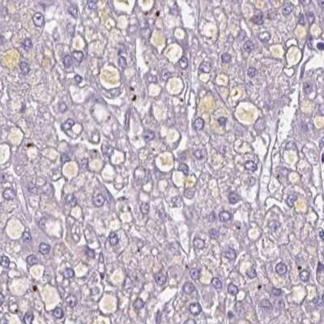 Immunohistochemistry: CEMP1 Antibody [NBP2-31682] - liver cancer