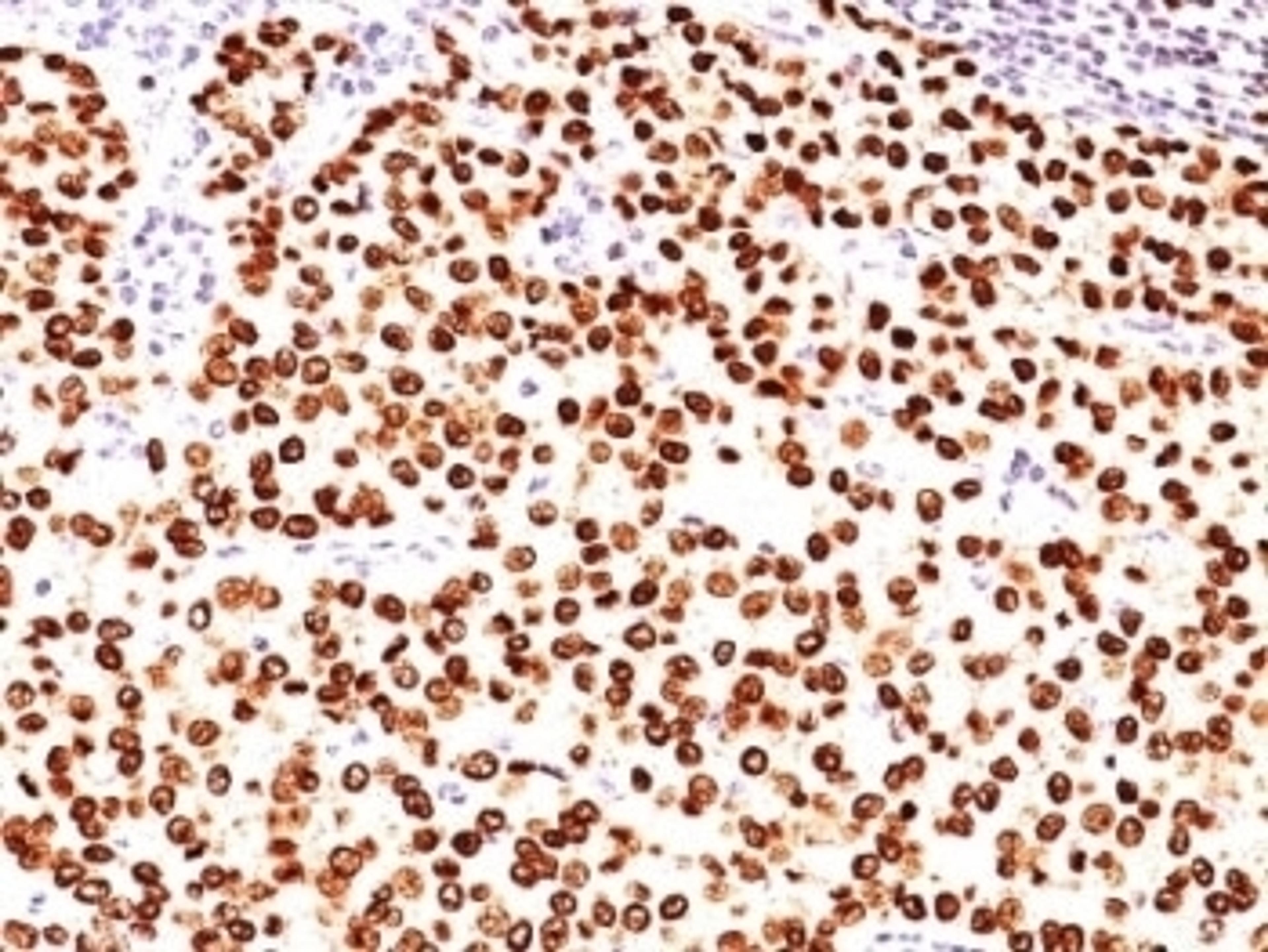 Formalin-fixed, paraffin-embedded human breast carcinoma stained with anti-Progesterone Receptor antibody (SPM566).