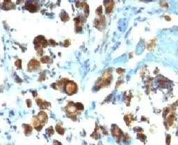 IHC testing of FFPE human gastric carcinoma with MUC3 antibody (clone MUCN3-1).