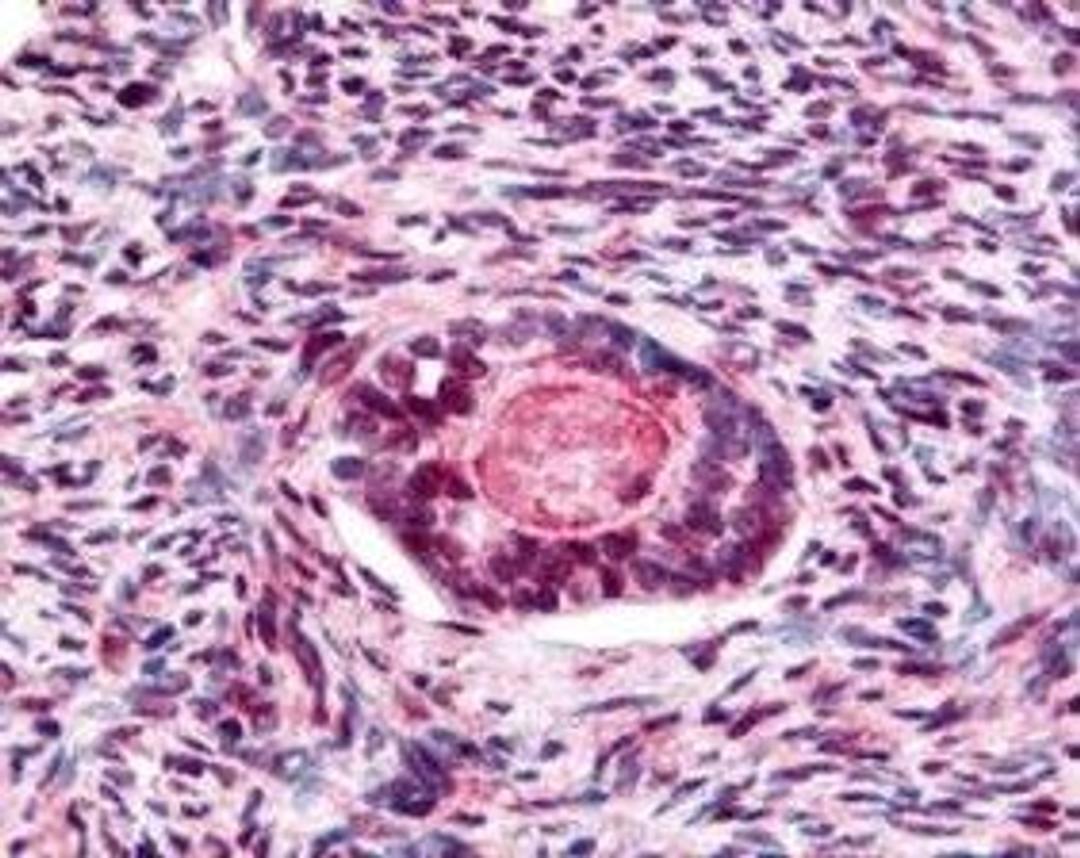 Immunohistochemical staining of human ovarian cancer tumor tissue using GSK3 Beta (phospho-S9) antibody