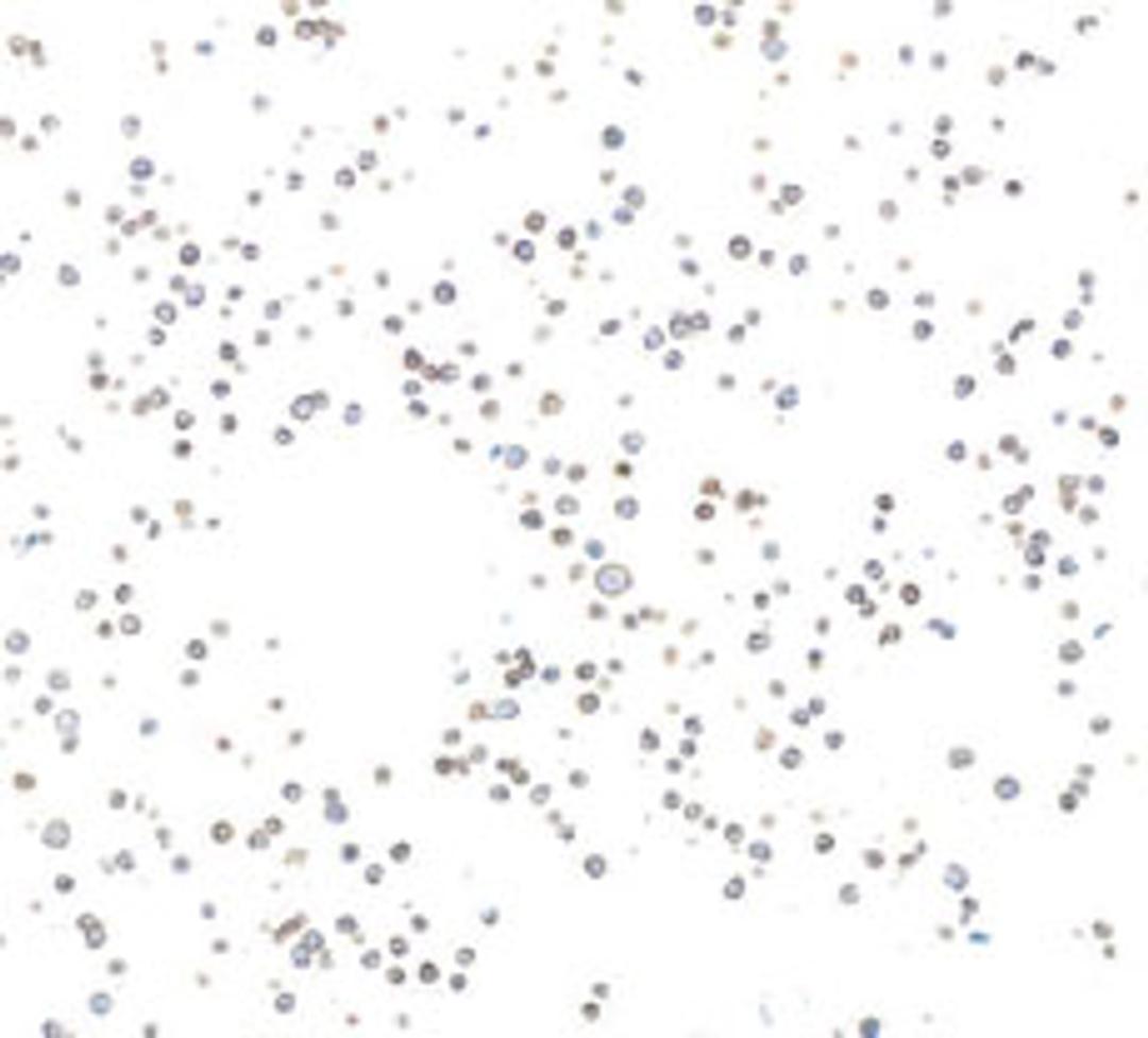 Detection of human CD19 in FFPE Raji cells by immunocytochemistry.