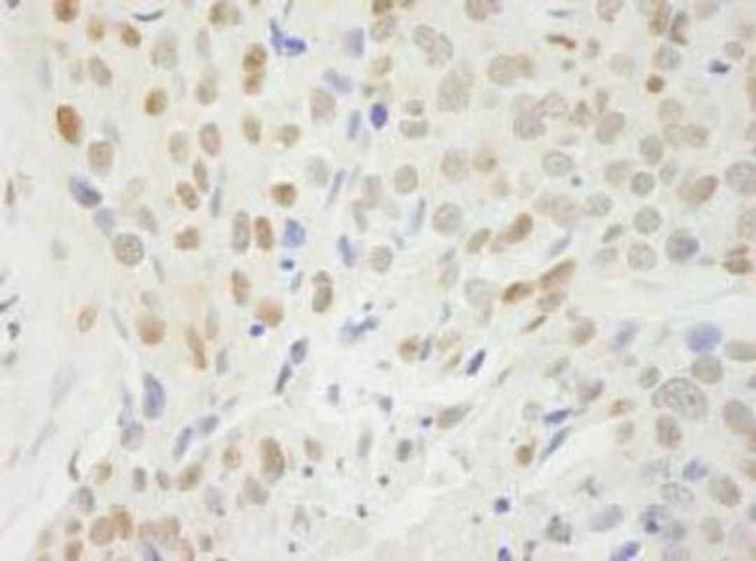 Immunohistochemistry-Paraffin: BCAS2 Antibody [NB110-40681] - Section of human breast carcinoma. Antibody: Affinity purified rabbit anti-BCAS2 used at a dilution of 1:250. Detection: DAB staining using Immunohistochemistry Accessory Kit