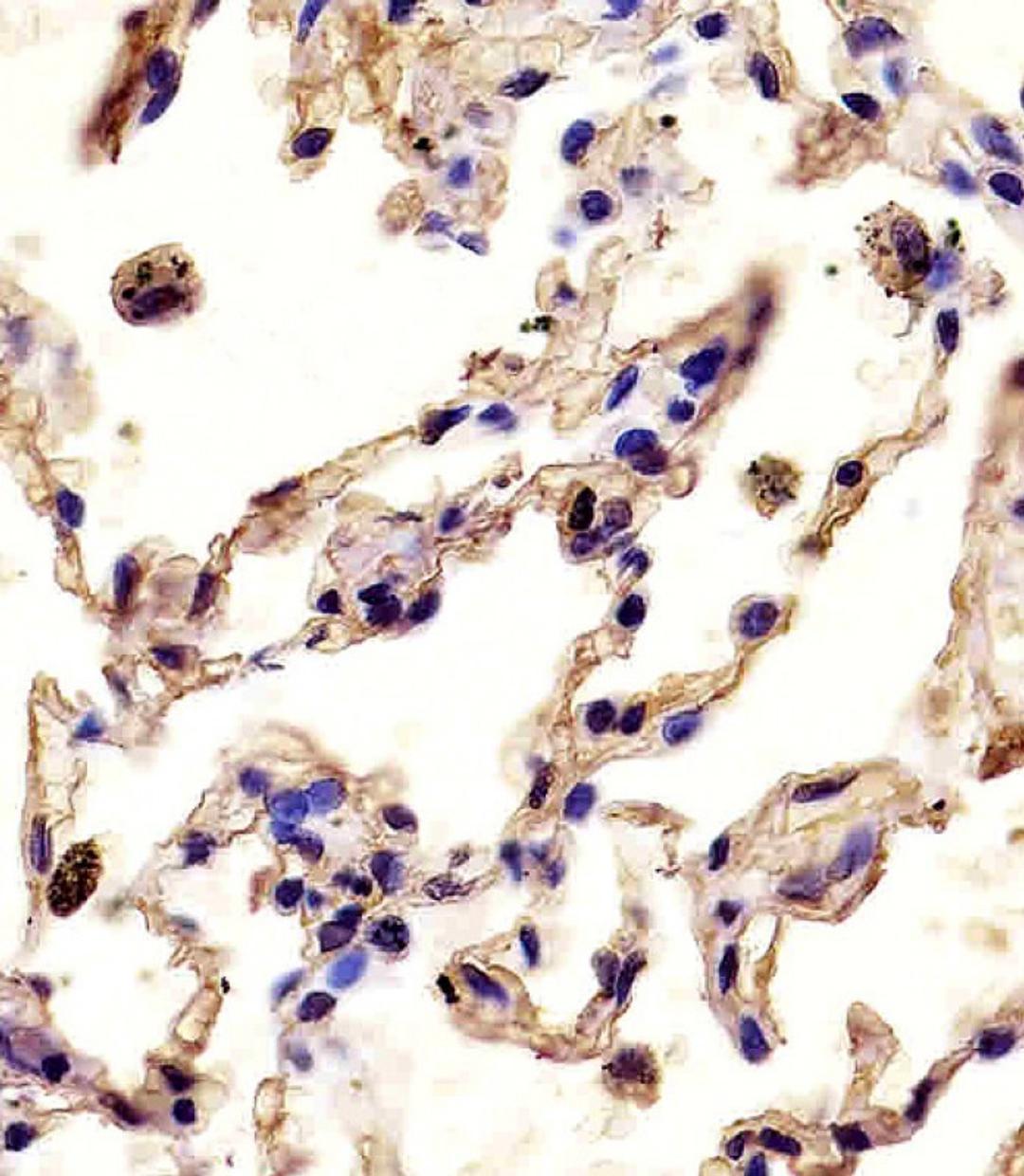 Antibody staining MMP12 in human lung tissue sections by Immunohistochemistry (IHC-P - paraformaldehyde-fixed, paraffin-embedded sections).