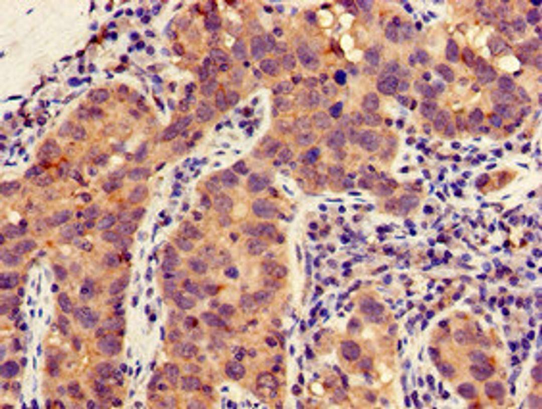 Immunohistochemistry of paraffin-embedded human pancreatic cancer using CSB-PA014636LA01HU at dilution of 1:100