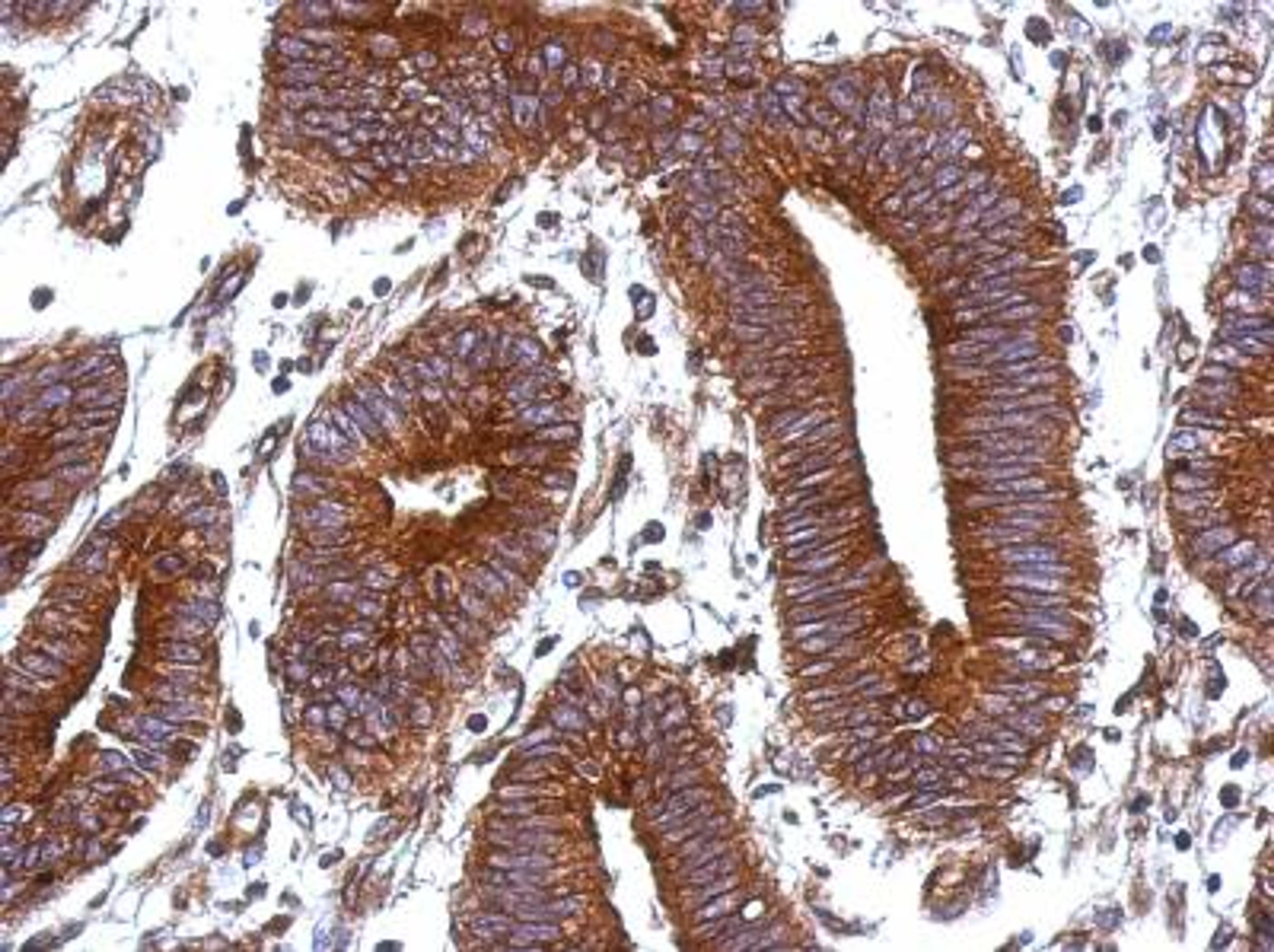 Immunohistochemistry-Paraffin: Vitronectin Antibody [NBP2-20866] - Analysis of Colon ca.