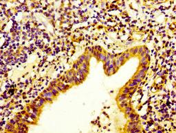 IHC image of CSB-PA011866LA01HU diluted at 1:400 and staining in paraffin-embedded human lung cancer performed on a Leica BondTM system. After dewaxing and hydration, antigen retrieval was mediated by high pressure in a citrate buffer (pH 6.0). Section was blocked with 10% normal goat serum 30min at RT. Then primary antibody (1% BSA) was incubated at 4&deg;C overnight. The primary is detected by a biotinylated secondary antibody and visualized using an HRP conjugated SP system.