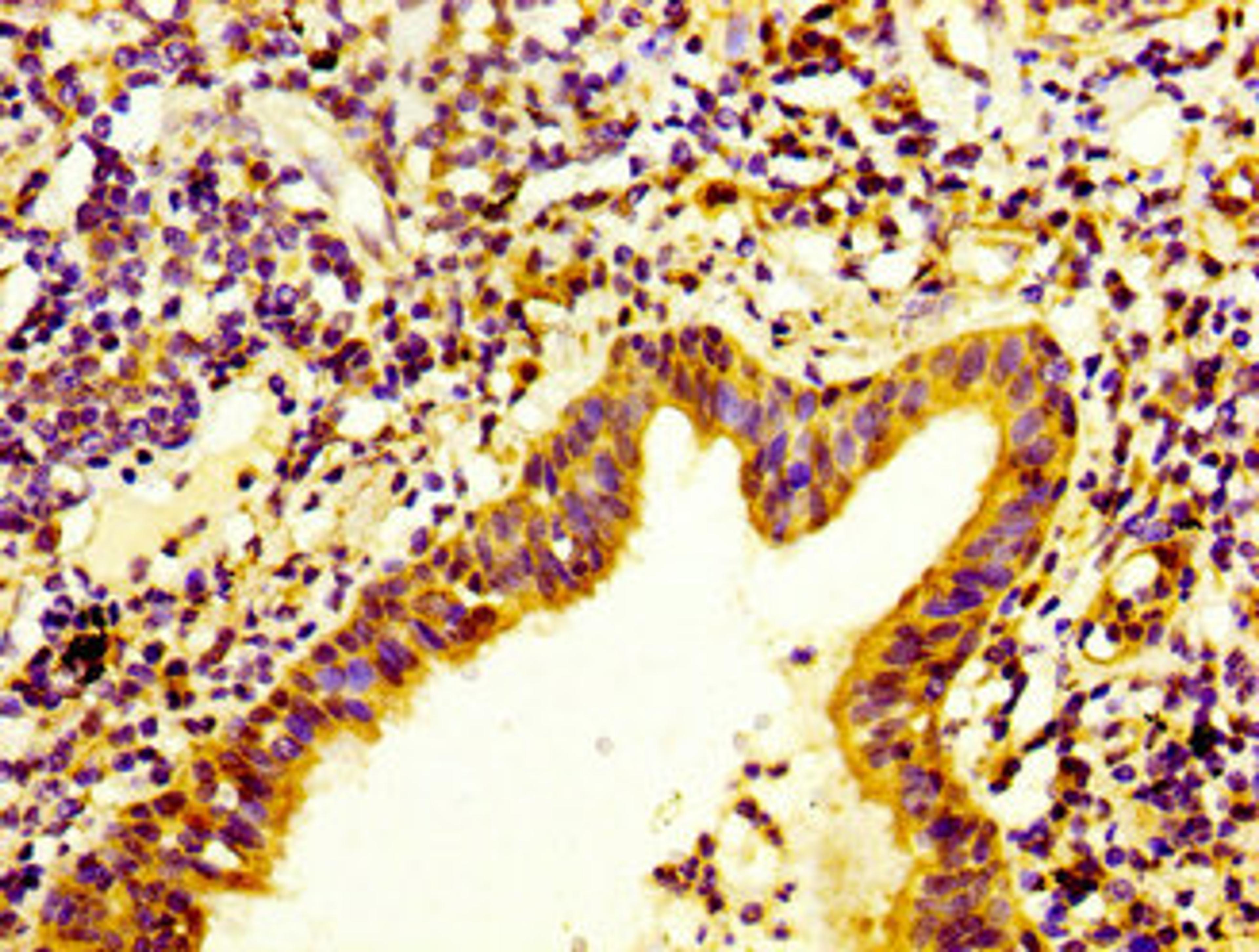 IHC image of CSB-PA011866LA01HU diluted at 1:400 and staining in paraffin-embedded human lung cancer performed on a Leica BondTM system. After dewaxing and hydration, antigen retrieval was mediated by high pressure in a citrate buffer (pH 6.0). Section was blocked with 10% normal goat serum 30min at RT. Then primary antibody (1% BSA) was incubated at 4&deg;C overnight. The primary is detected by a biotinylated secondary antibody and visualized using an HRP conjugated SP system.