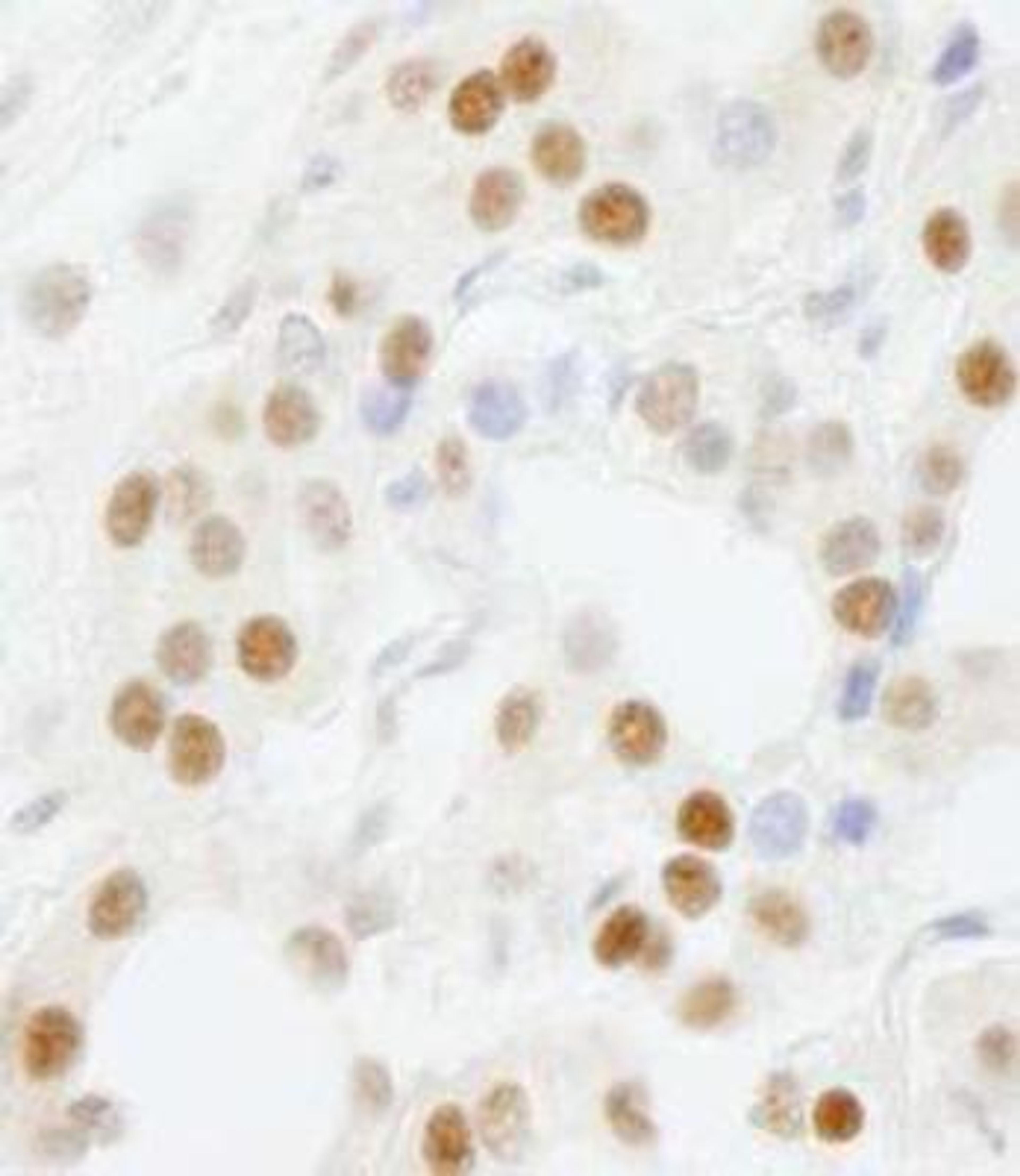 Immunohistochemistry-Paraffin: GTF3C5 Antibody [NB100-60435] - FFPE section of human thyroid carcinoma.  Antibody dilution of 1:500.