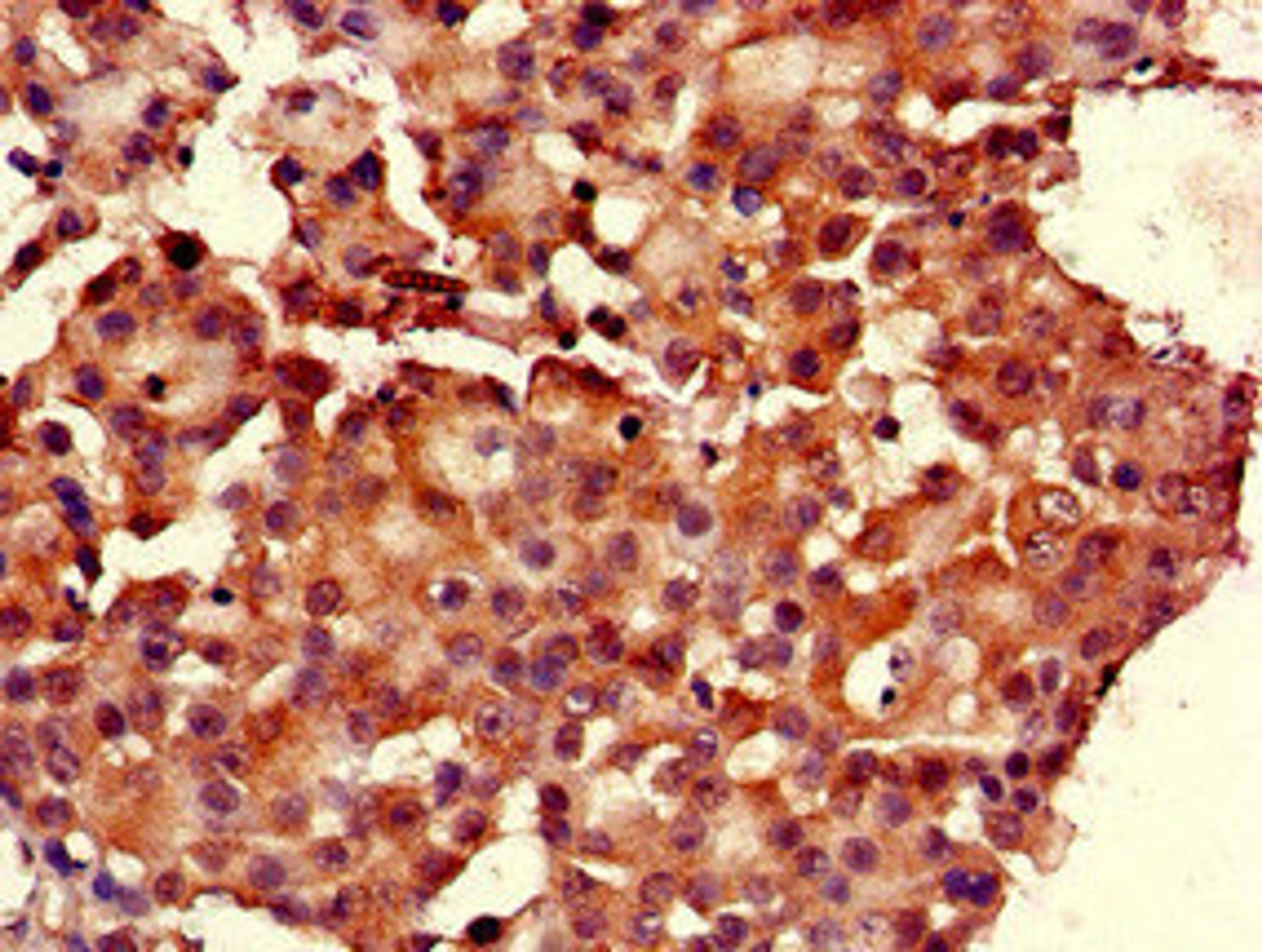 Immunohistochemistry of paraffin-embedded human breast cancer using CSB-PA019650LA01HU at dilution of 1:100