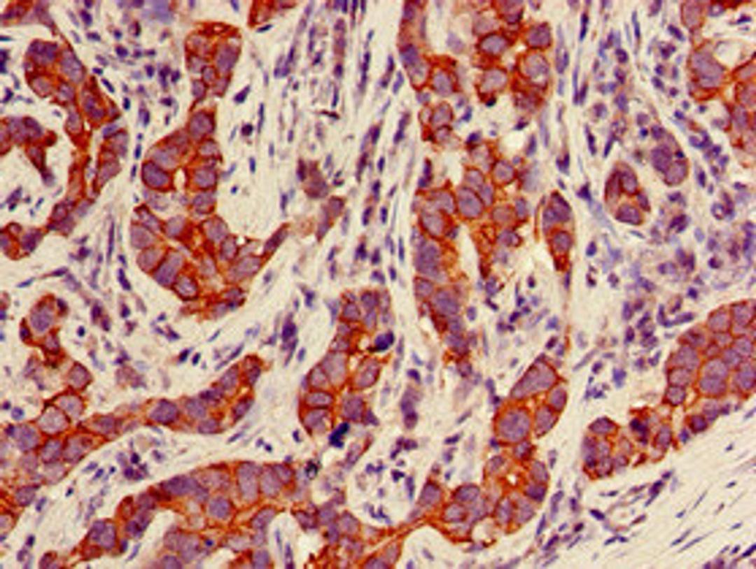 Immunohistochemistry of paraffin-embedded human pancreatic cancer using CSB-PA10629D0Rb at dilution of 1:100