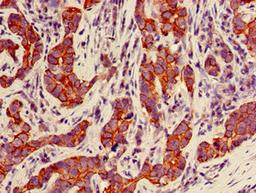 Immunohistochemistry of paraffin-embedded human pancreatic cancer using CSB-PA10629D0Rb at dilution of 1:100