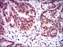 Immunohistochemistry: GCNF/NR6A1 Antibody (4G8) [NBP2-37467] - Immunohistochemical analysis of paraffin-embedded rectum cancer tissues using NR6A1 mouse mAb with DAB staining.