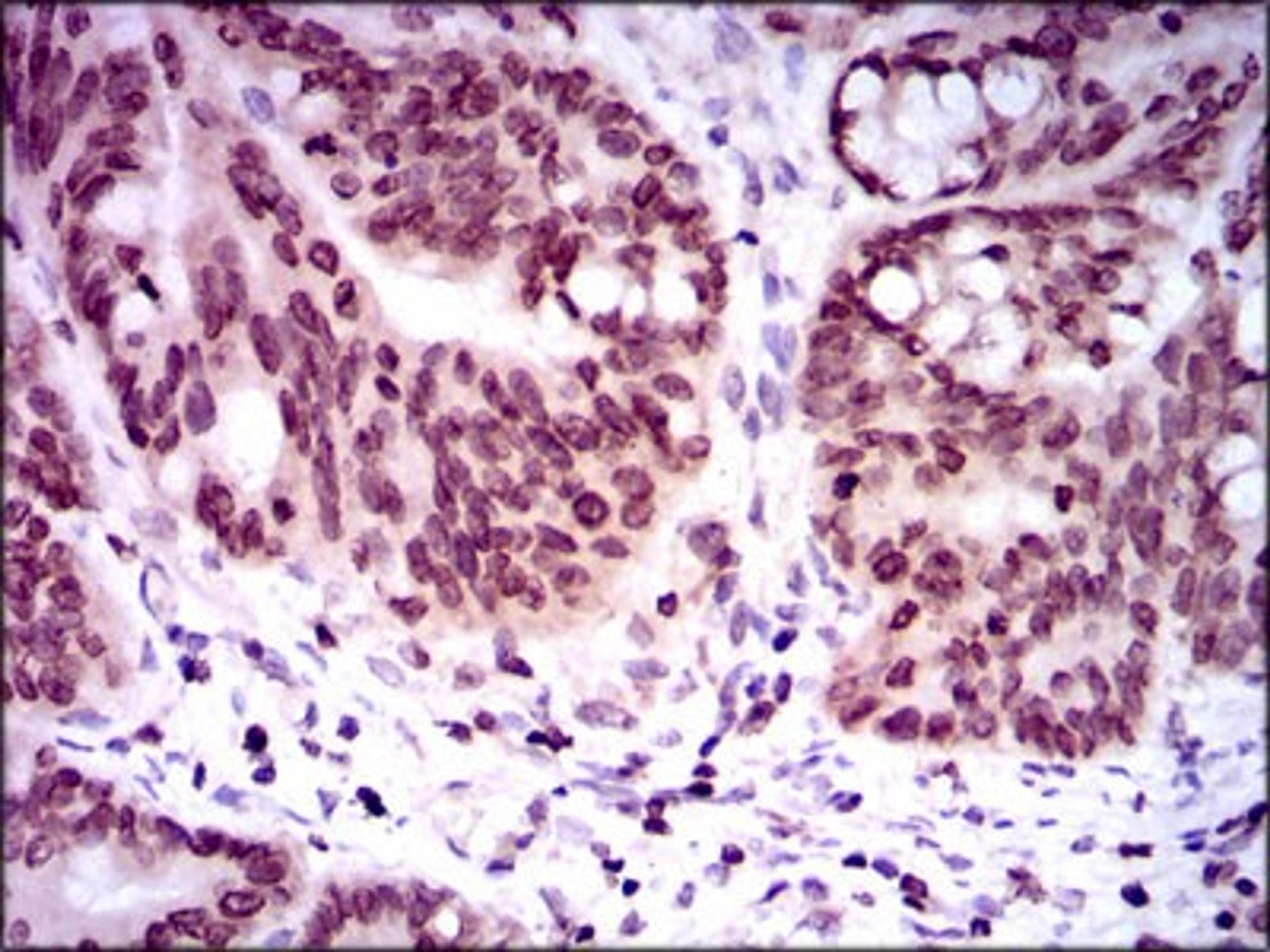 Immunohistochemistry: GCNF/NR6A1 Antibody (4G8) [NBP2-37467] - Immunohistochemical analysis of paraffin-embedded rectum cancer tissues using NR6A1 mouse mAb with DAB staining.