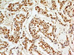 Immunohistochemistry-Paraffin: APIP Antibody (19F461) [NB100-56567] - Formalin-fixed, paraffin-embedded adenocarcinoma of the breast stained with APIP antibody (5 ug/ml), peroxidase-conjugate and DAB chromogen. Staining of formalin-fixed tissues is enhanced by boiling tissue sections in 10 mM sodium citrate buffer, pH 6.0 for 10-20 min followed by cooling at RT for 20 min.