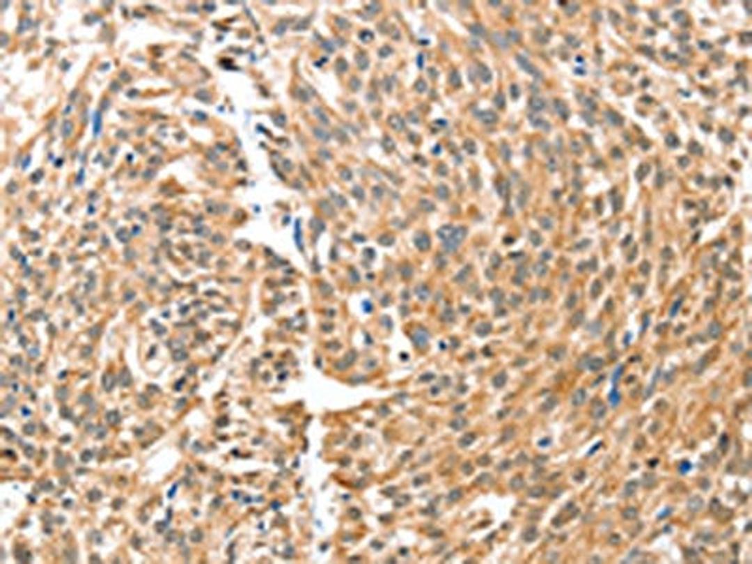 The image on the left is immunohistochemistry of paraffin-embedded Human esophagus cancer tissue using CSB-PA052042(BAX Antibody) at dilution 1/30, on the right is treated with fusion protein. (Original magnification: ×200)