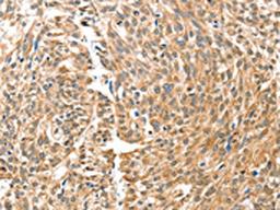 The image on the left is immunohistochemistry of paraffin-embedded Human esophagus cancer tissue using CSB-PA052042(BAX Antibody) at dilution 1/30, on the right is treated with fusion protein. (Original magnification: ×200)