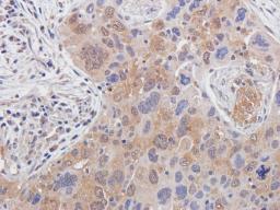 IHC-P image of human lung cancer tissue using GLP2 antibody (2.5 ug/ml)