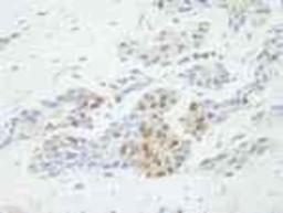 Immunohistochemistry-Paraffin: 53BP2 Antibody [NB100-2859] - FFPE section of human prostate adenocarcinoma.  Affinity purified rabbit anti-ASPP2 at a dilution of 1:500.