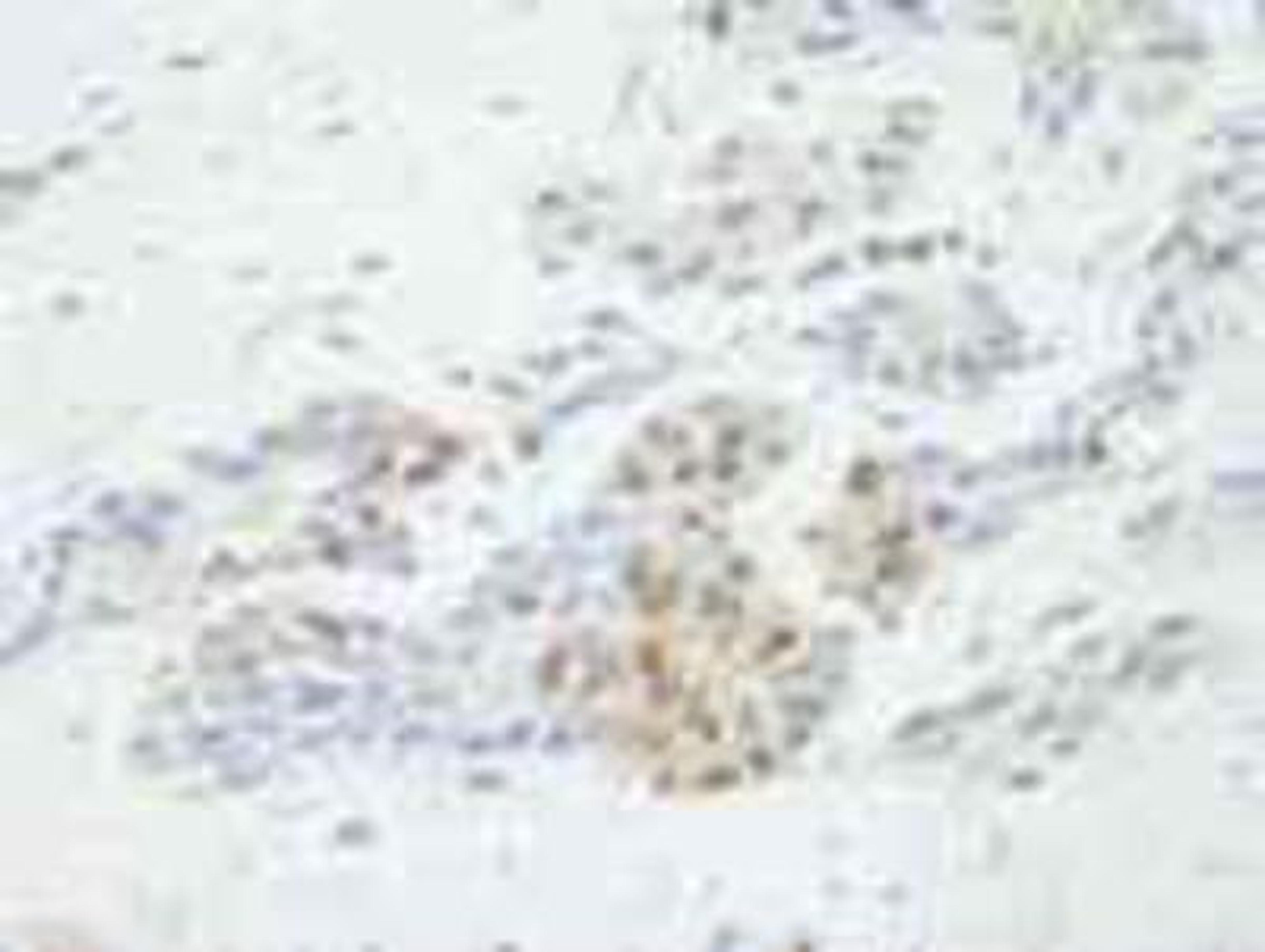 Immunohistochemistry-Paraffin: 53BP2 Antibody [NB100-2859] - FFPE section of human prostate adenocarcinoma.  Affinity purified rabbit anti-ASPP2 at a dilution of 1:500.