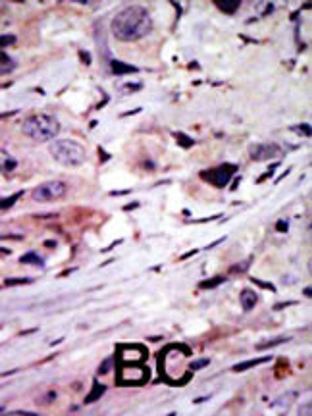 Formalin-fixed and paraffin-embedded human cancer tissue reacted with the primary antibody, which was peroxidase-conjugated to the secondary antibody, followed by AEC staining. BC = breast carcinoma; HC = hepatocarcinoma.