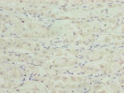 Immunohistochemistry of paraffin-embedded human gastric cancer using CSB-PA768209LA01HU at dilution of 1:100