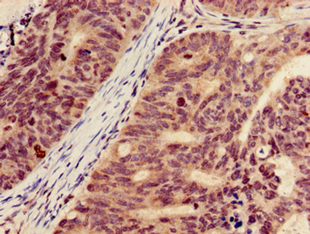 Immunohistochemistry of paraffin-embedded human colon cancer using CSB-PA010418OA18nacHU at dilution of 1:100