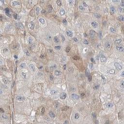 Immunohistochemistry: CD239 Antibody [NBP2-31994] - liver cancer