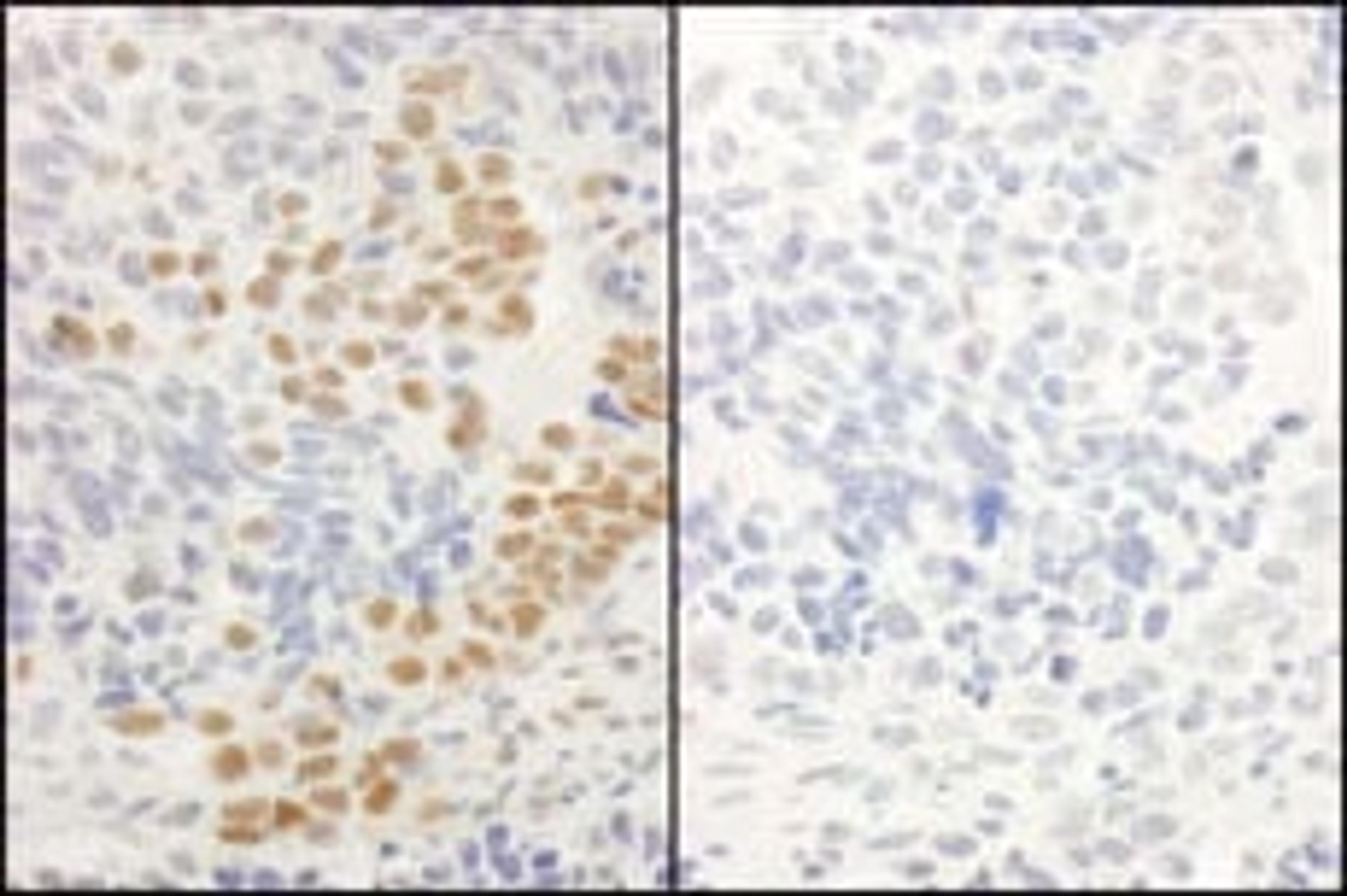 Detection of human Phospho-RelA (S536) by immunohistochemistry.