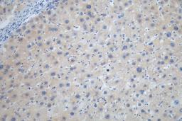 IHC image of CSB-RA207790A0HU diluted at 1:100 and staining in paraffin-embedded human liver cancer performed on a Leica BondTM system. After dewaxing and hydration, antigen retrieval was mediated by high pressure in a citrate buffer (pH 6.0). Section was blocked with 10% normal goat serum 30min at RT. Then primary antibody (1% BSA) was incubated at 4°C overnight. The primary is detected by a Goat anti-rabbit polymer IgG labeled by HRP and visualized using 0.05% DAB.