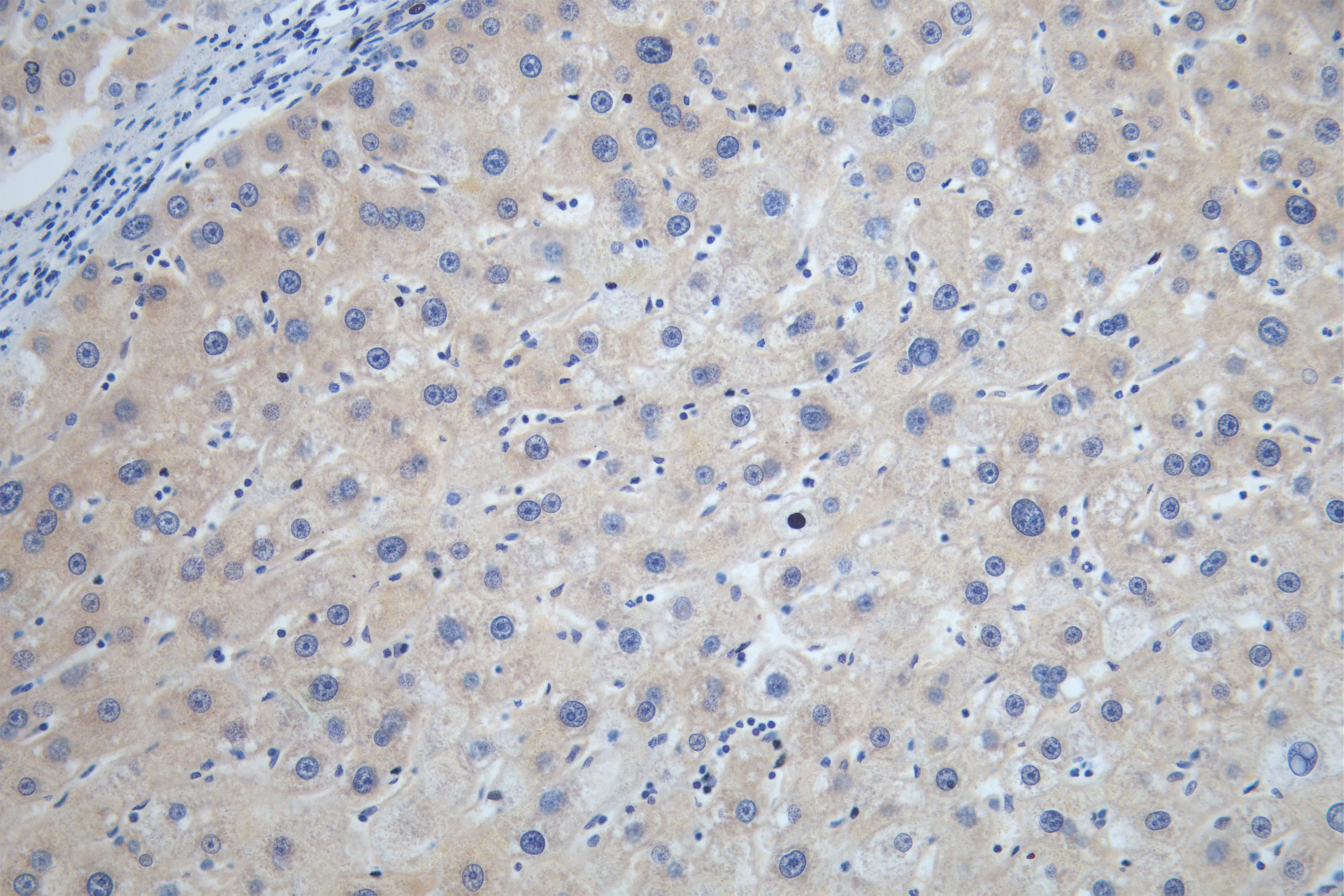 IHC image of CSB-RA207790A0HU diluted at 1:100 and staining in paraffin-embedded human liver cancer performed on a Leica BondTM system. After dewaxing and hydration, antigen retrieval was mediated by high pressure in a citrate buffer (pH 6.0). Section was blocked with 10% normal goat serum 30min at RT. Then primary antibody (1% BSA) was incubated at 4°C overnight. The primary is detected by a Goat anti-rabbit polymer IgG labeled by HRP and visualized using 0.05% DAB.