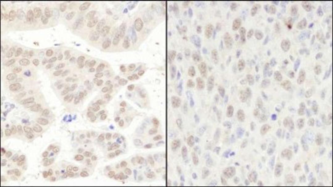 Immunohistochemistry-Paraffin: CCAR1 Antibody [NB500-186] - Human stomach carcinoma (left) and mouse squamous cell carcinoma (right). Antibody used at a dilution of 1:1000 (1ug/ml).