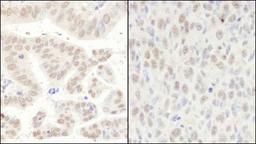 Immunohistochemistry-Paraffin: CCAR1 Antibody [NB500-186] - Human stomach carcinoma (left) and mouse squamous cell carcinoma (right). Antibody used at a dilution of 1:1000 (1ug/ml).