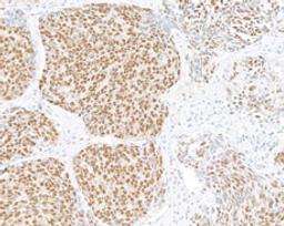 Detection of human UBQLN4 in FFPE lung carcinoma by immunohistochemistry.