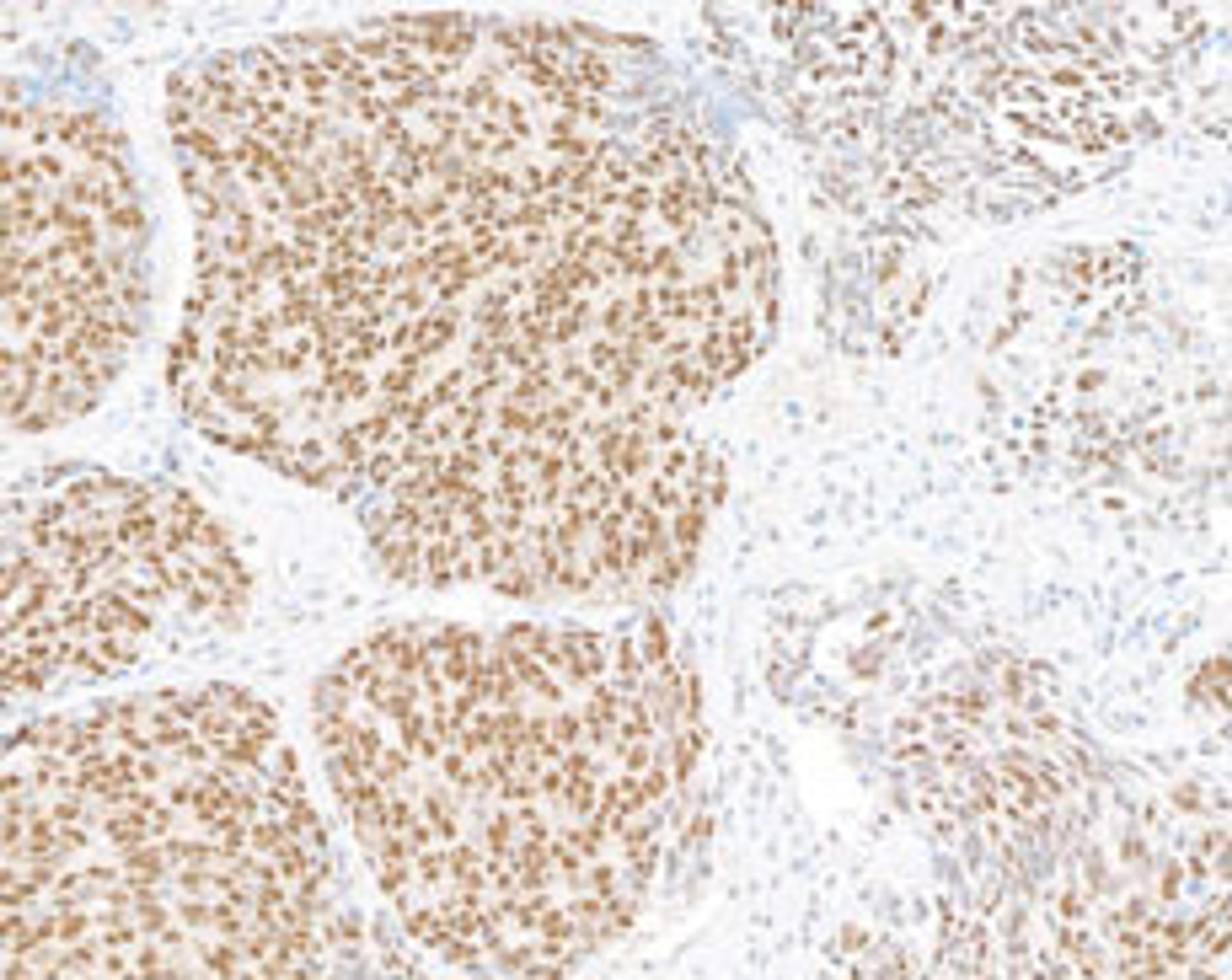 Detection of human UBQLN4 in FFPE lung carcinoma by immunohistochemistry.