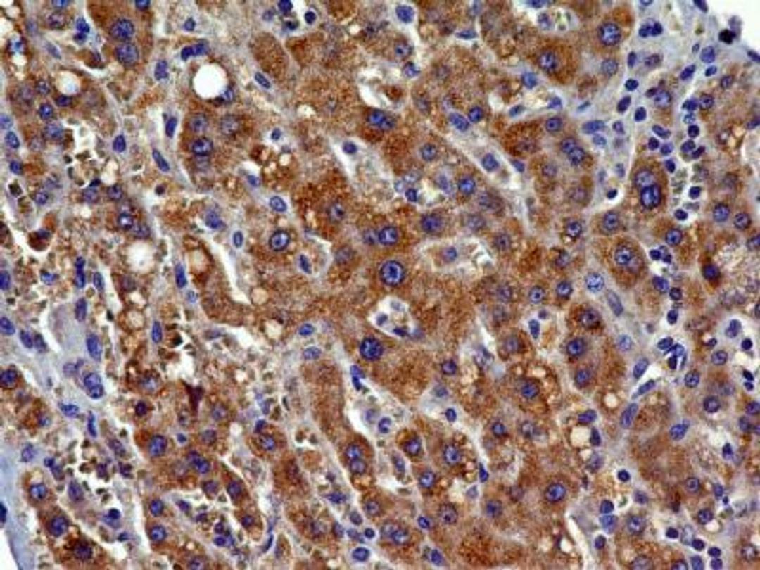 Immunohistochemistry-Paraffin: CCR2 Antibody (3G7) [NBP2-35334] - IHC analysis of formalin-fixed paraffin-embedded tissue section of human HCC (hepatocellular carcinoma / malignant hepatoma) using CCR2 antibody (clone 3G7) at 5 ug/ml concentration. The cancer cells depicted specific punctate to diffused cytoplasmic-membranous immuno-staining of CCR2 protein.