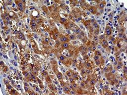 Immunohistochemistry-Paraffin: CCR2 Antibody (3G7) [NBP2-35334] - IHC analysis of formalin-fixed paraffin-embedded tissue section of human HCC (hepatocellular carcinoma / malignant hepatoma) using CCR2 antibody (clone 3G7) at 5 ug/ml concentration. The cancer cells depicted specific punctate to diffused cytoplasmic-membranous immuno-staining of CCR2 protein.