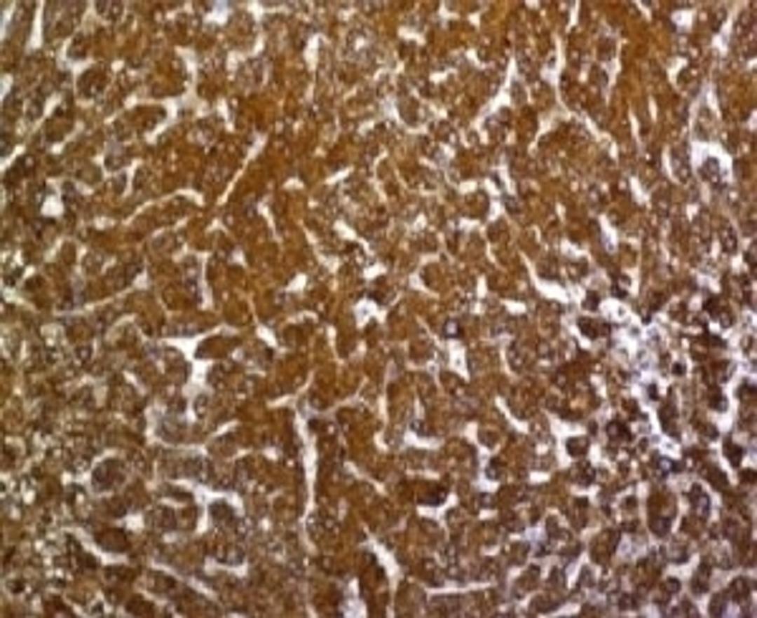 IHC testing of FFPE human hepatocellular carcinoma with Glypican-3 antibody (SGPN3-1).