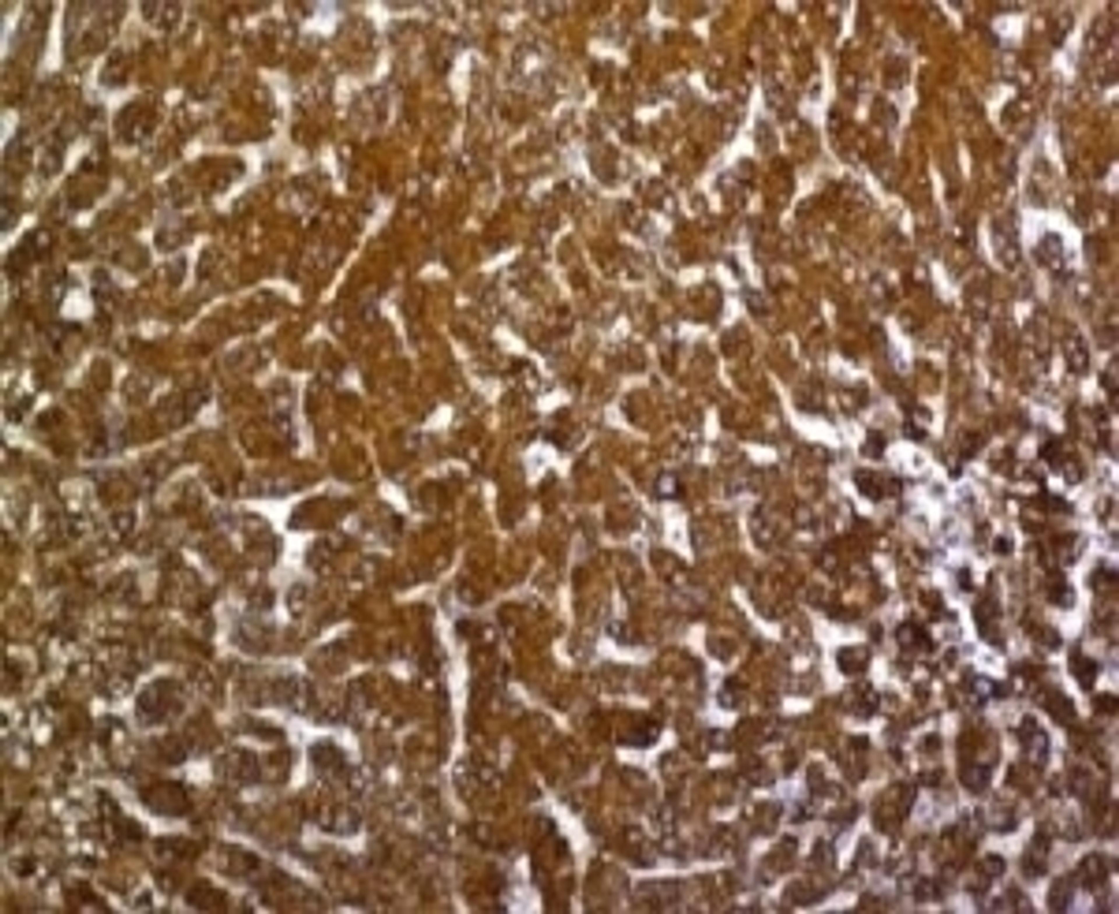 IHC testing of FFPE human hepatocellular carcinoma with Glypican-3 antibody (SGPN3-1).