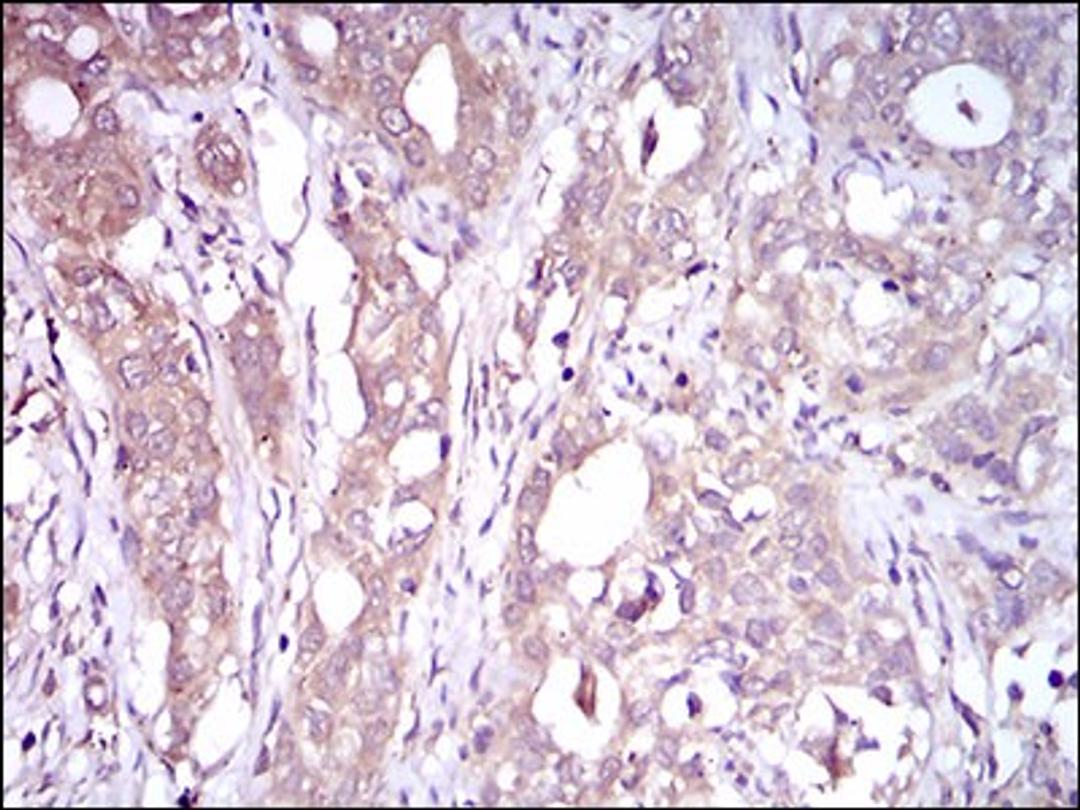 Immunohistochemistry: C1q R1/CD93 Antibody (1A10E10) [NBP2-37308] - Immunohistochemical analysis of paraffin-embedded cervical cancer tissues using CD93 mouse mAb with DAB staining.