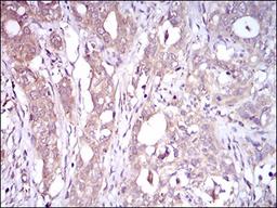 Immunohistochemistry: C1q R1/CD93 Antibody (1A10E10) [NBP2-37308] - Immunohistochemical analysis of paraffin-embedded cervical cancer tissues using CD93 mouse mAb with DAB staining.