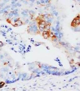 Immunohistochemical analysis of paraffin-embedded Endometrial carcinoma section using GST pi antibody