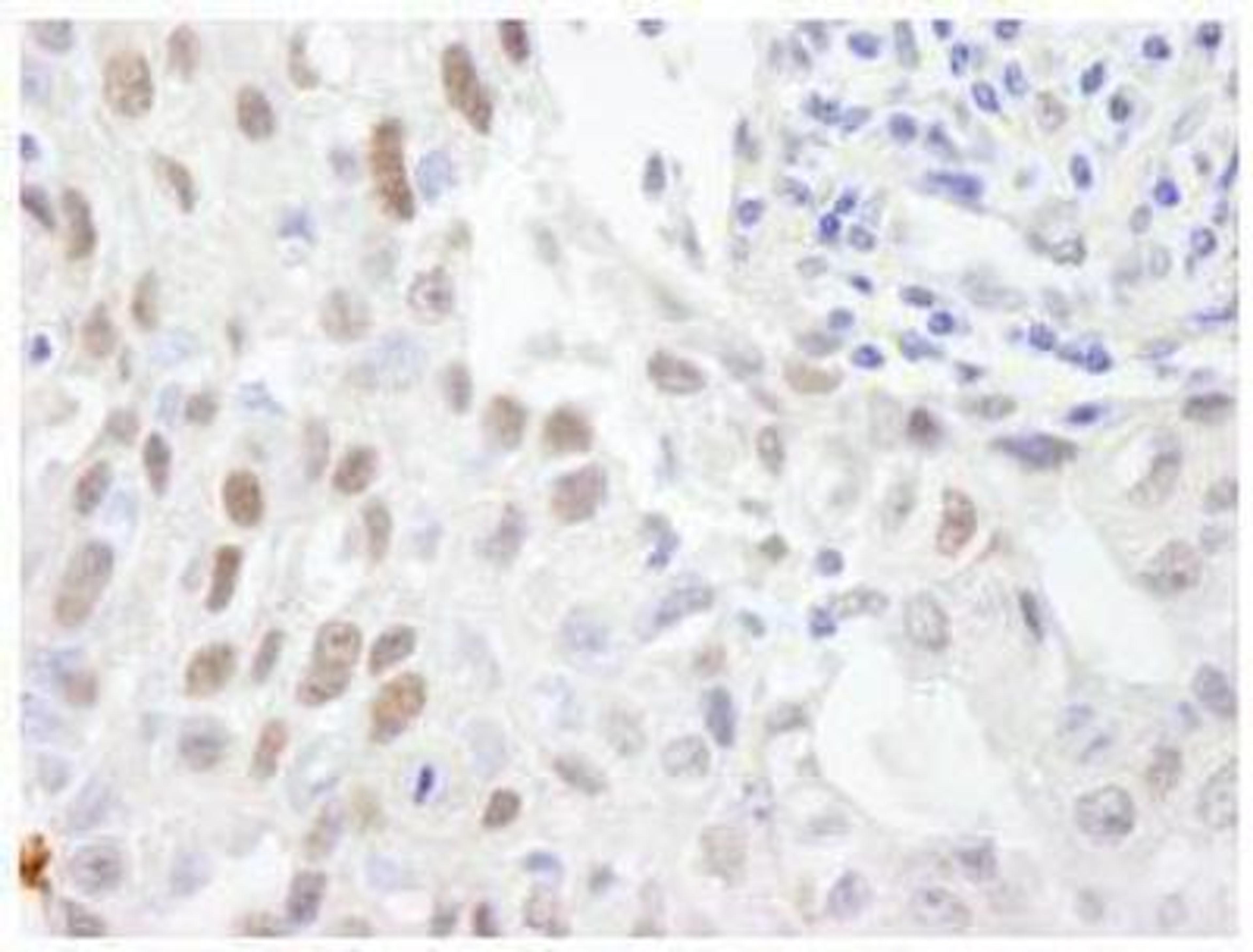 Immunohistochemistry-Paraffin: ZHX3 Antibody [NB100-68220] - FFPE section of human breast carcinoma. Affinity purified rabbit anti-ZHX3 used at a dilution of 1:500. Detection: DAB staining using Immunohistochemistry Accessory Kit