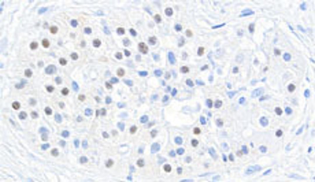 Detection of human MAFB in FFPE pancreatic tumor by immunohistochemistry.