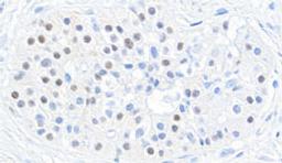 Detection of human MAFB in FFPE pancreatic tumor by immunohistochemistry.