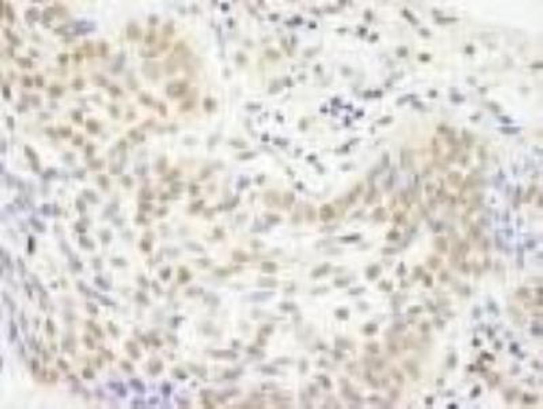 Immunohistochemistry-Paraffin: KDM2A/FBXL11 Antibody [NB100-74602] - FFPE section of human skin basal cell carcinoma.  Affinity purified rabbit anti-JHDM1A  used at a dilution of 1:250.